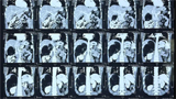 World’s largest Adrenal Tumor removed robotically at Delhi hospital